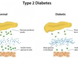 diabetes type 2