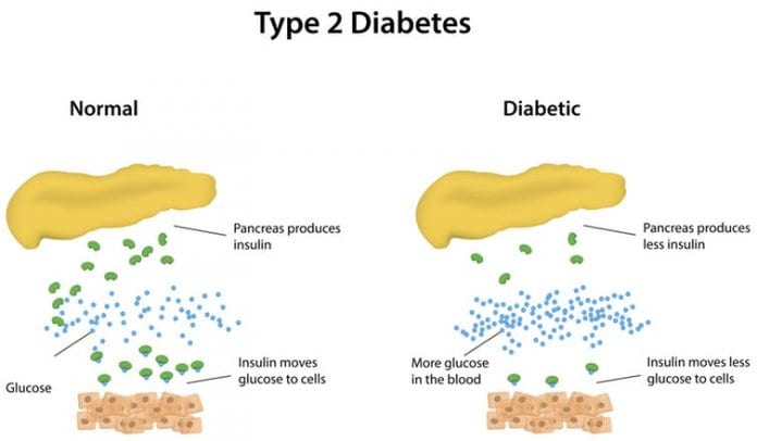 diabetes type 2